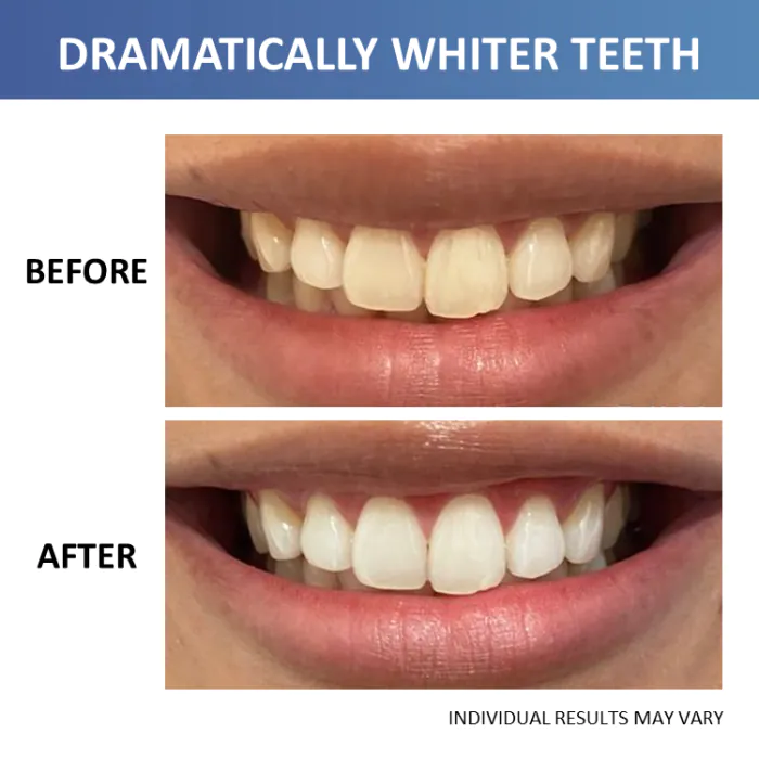 Crest 3DWhitestrips Professional White with LED Accelerator Light